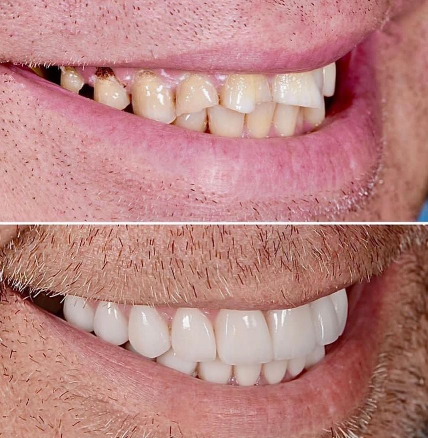 Hollywood Smile complet